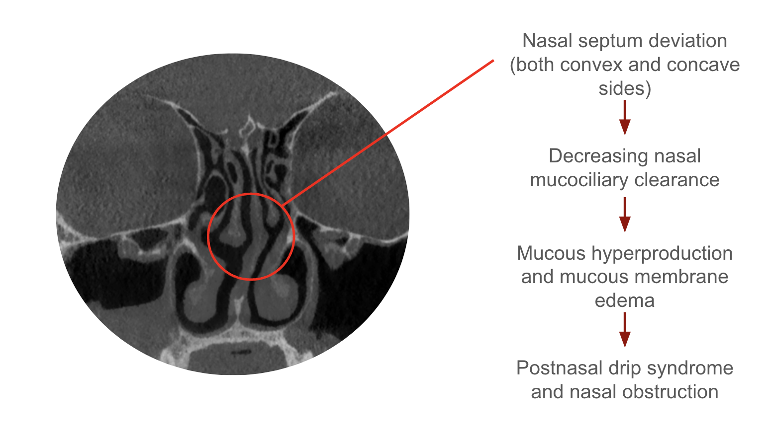 Types of the nasal septum deviations and their influence on the state of mucociliary clearance of the nasal cavity in patients with postnasal obstruction syndrome