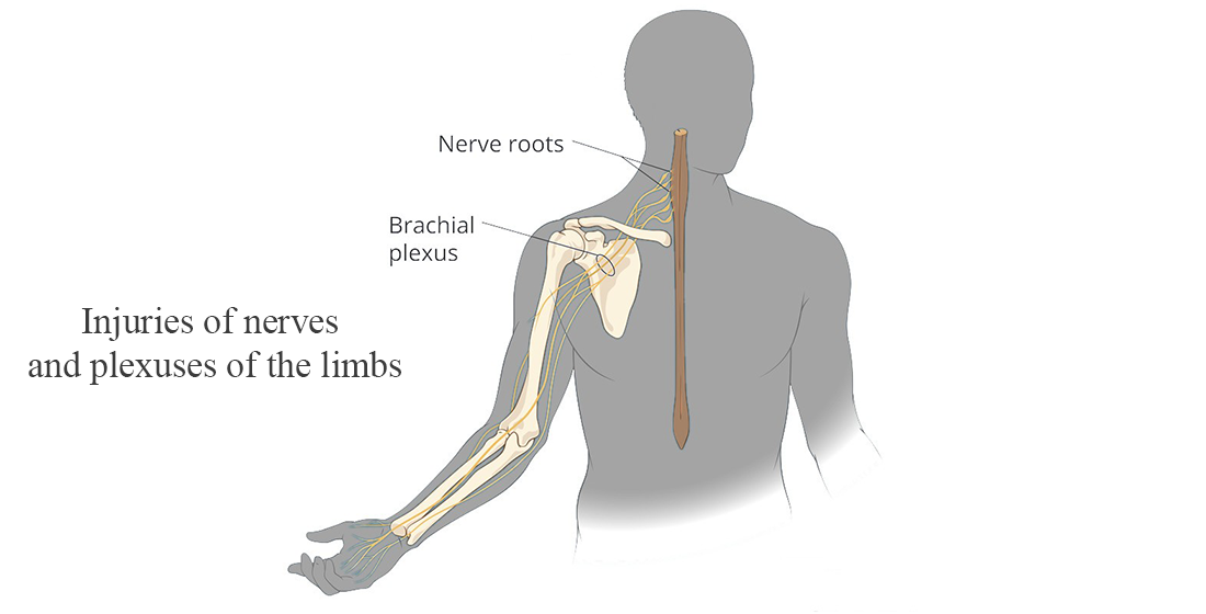 Гострі больові синдроми при ушкодженнях нервів та сплетінь кінцівок