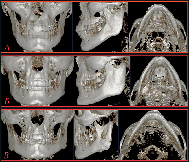 Peculiarities of the shape and size of the mandible and the lower dentition with taking into account gender and craniotype