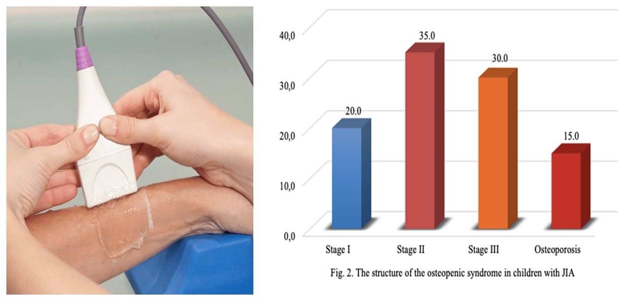 The role of ultrasound densitometry for screening diagnostics of osteopenia in children with juvenile idiopathic arthritis