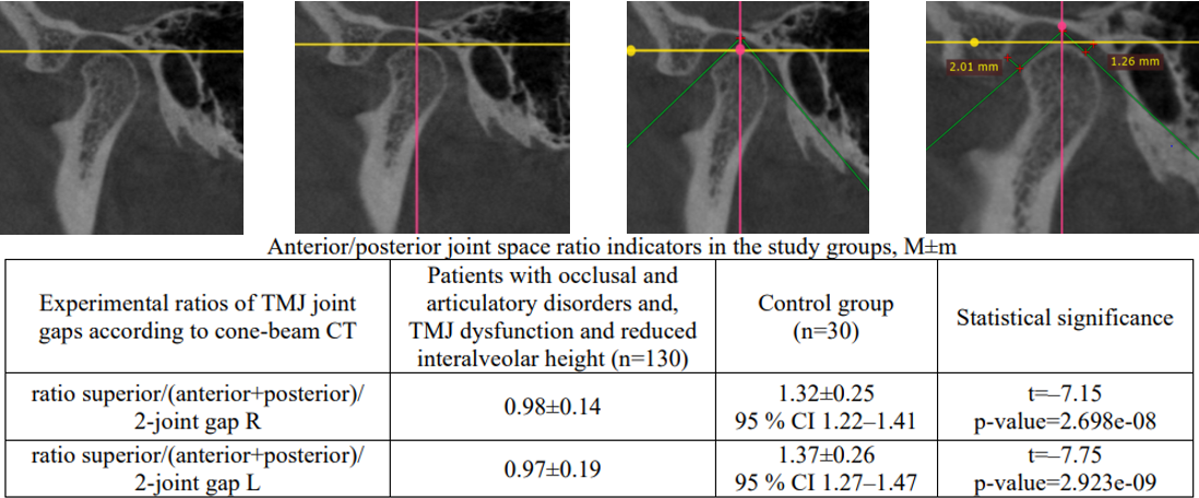 Assessment of interalveolar height deficiency using computed tomography in patients with TMJ dysfunction in articulation-occlusion disorders