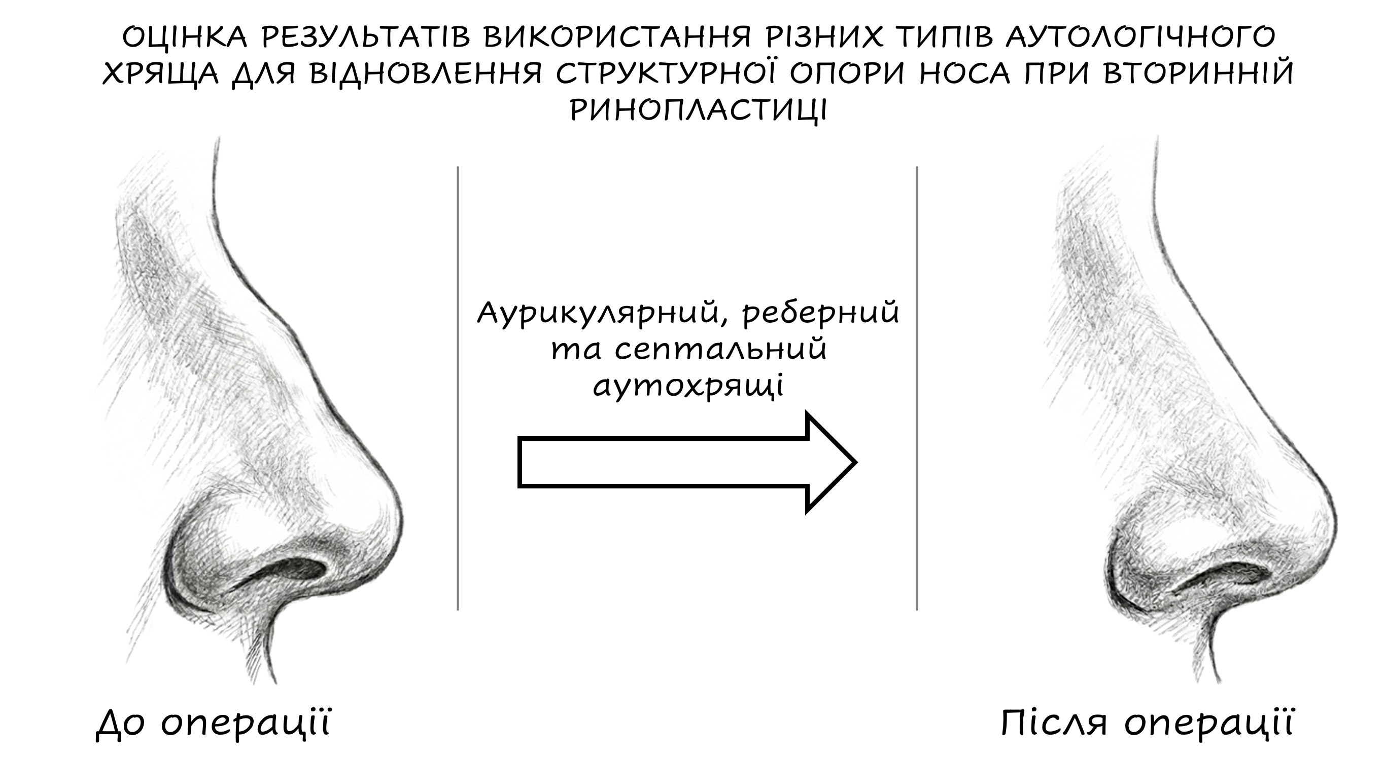 Evaluation of the results of the use of different types of autologous cartilage for restoration of structural support of the nose in secondary rhinoplasty