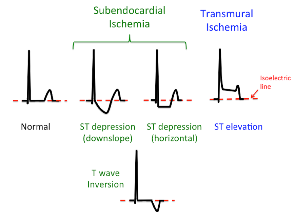 Discrete electrocardiogram T amplitude detection based on cycle duration
